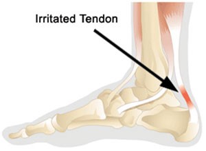 Achilles Tendonitis Premier Orthotics Lab