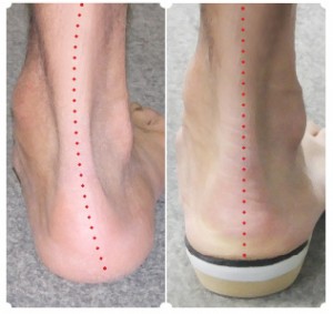 Benefits of Orthotics