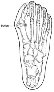 Bunions Premier Orthotics Lab